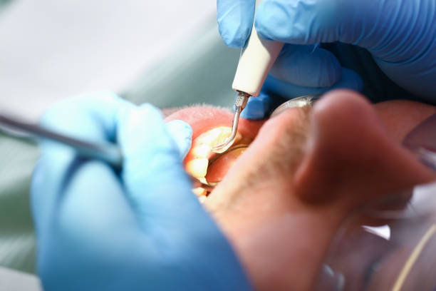 Best Emergency Wisdom Teeth Removal in Sutter Creek, CA
