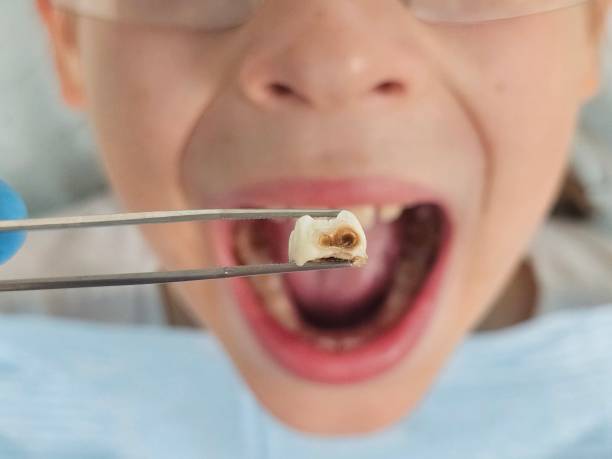Best Emergency Tooth Extraction in Sutter Creek, CA